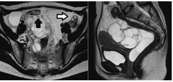 図 1 骨盤部単純 MRI（T2 強調画像） 左（水平断）：両側卵巣（⬆：右卵巣 ! ：左卵巣）は正常に描出されている． 右（矢状断）：ダグラス窩から子宮の頭側にかけて多嚢胞性病変を認める． 図 2 摘出標本肉眼像 嚢胞性病変を多数認める 図 3 （HE 染色） 左：種々の厚さの嚢胞壁を認める． 右：嚢胞壁内腔は一層の中皮細胞に覆われている． 腹腔鏡手術を施行した多嚢胞性腹膜中皮腫の 2 例 ５７