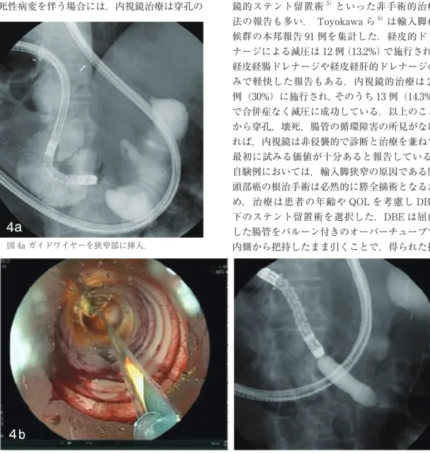 図 4a ガイドワイヤーを狭窄部に挿入． 図 4b　狭窄部を大腸用バルーンにて拡張 ある．血液検査所見では高アミラーゼ血症を呈することが多く，機序は十二指腸膨満による膵循環障害と推定されている．画像診断では腹部CT 検査や超音波検査が有用で，大動脈前面のdumbbel 型に拡張した十二指腸が特徴的である1）．腸管内容の排出障害の程度により急性と慢性に分けられ，急性輸入脚症候群では進行すれば腸管の壊死，穿孔を来たし重篤な経過を辿るため早期に適切な処置をとる必要がある．壊死性病変を伴う場合には，内視鏡治療は穿孔