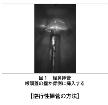 図 1 逆行性挿菅 喉頭蓋の僅か腹側に挿入する