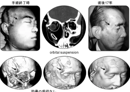 図 4d　術後 17 年経過時の顔貌と移植骨の状態  図 4c  ２系統血管柄付き第Ⅵ肋骨・腹直筋皮弁による上顎・中頭蓋底欠損の再建 