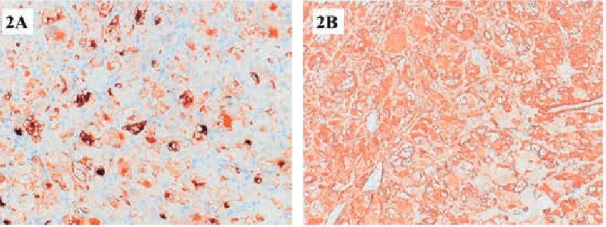 FIG 2. Immunohistochemical findings. Neoplastic cells demonstrate the positivity for Melanosome- Melanosome-related antigen (HMB45) (A) and alpha smooth muscle actin (B)