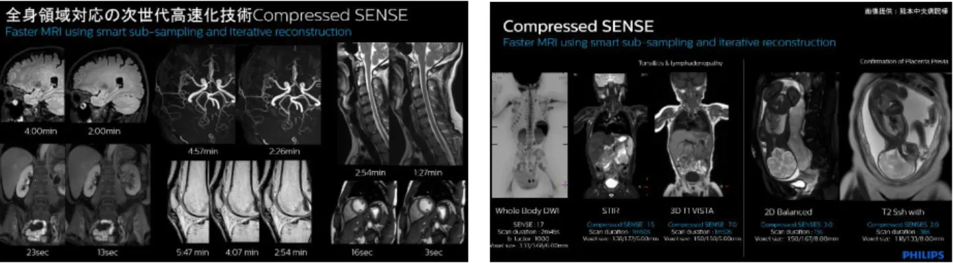 図 8.  適応範囲の広い Compressed SENSE    図 9. Compressed SENSE を用いた小児 MRI 画像 