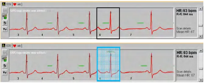 図 1. ECG 編集(6 心拍目のデータの除去) 