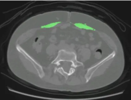 Fig. 4 Recognition result of the rectus abdominis muscle.