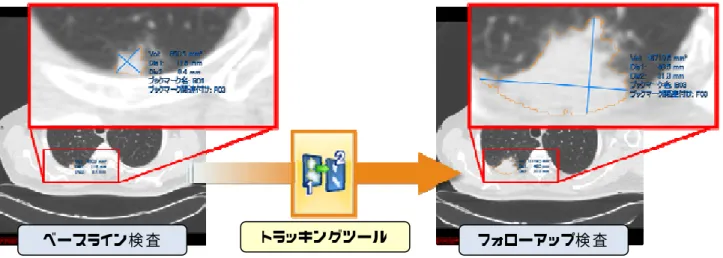 図 3  トラッキングツールによる標 的 病 変 の自 動 検 出 例  
