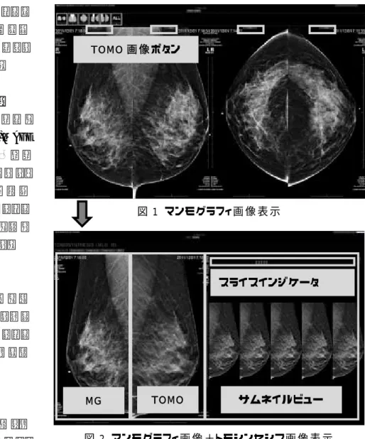 図 2  マンモグラフィ画 像 ＋トモシンセシス画 像 表 示  TOMO 画 像 ボタン スライスインジケータ サムネイルビュー TOMO MG 15.  乳 腺 総 合 画 像 診 断 環 境 XTREK MAMMO の新 機 能    