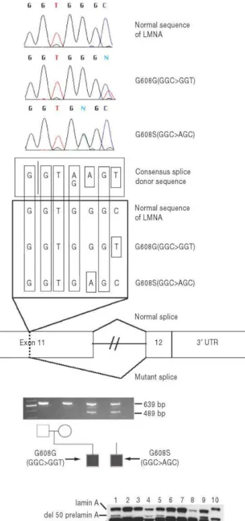 FIGURE 2. Point mutations in exon 11  of LMNA cause HGPS. 
