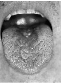 Fig 1 Case 1 : Clinical appearance of intraoral view at the first visit.