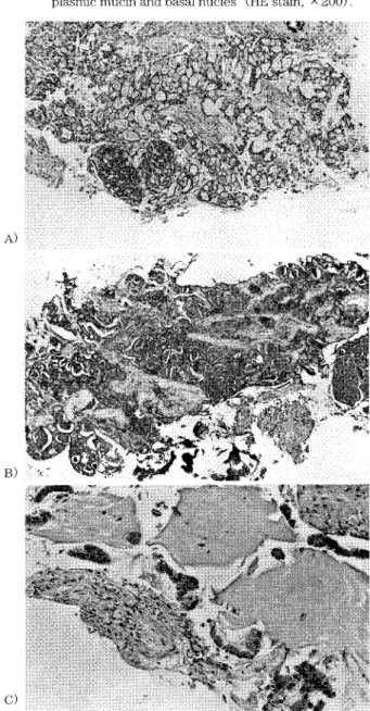 Fig.  6.  The  histological  findings  of  a  transbronchial  lung  bi- bi-opsy  performed  in  another  hospital.