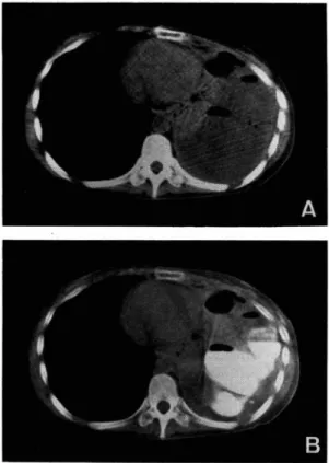 Fig.  3  Analysis  of  the  CT  findings  concerning  the    period  after  the  initial  instillation