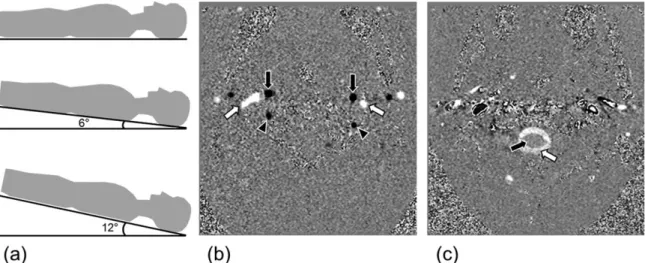 FIGURE 1: Schematic diagrams of the three different tilt angle positions and velocity-mapped phase images: (a) horizontal supine position (top), slight head-down tilt position (middle), and moderate head-down tilt position (bottom), (b) velocity-mapped pha