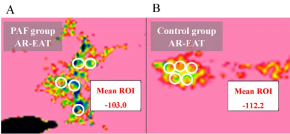 Fig. 2. Representative measurement of EAT density. (A) Predeﬁned plain computed tomography image from a paroxysmal atrial ﬁbrillation patient, and (B) a control patient.
