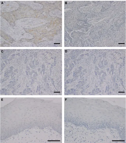 Figure 2 Immunohistochemical stain of Vascular endothelial growth factor-C (VEGF-C) in squamous cell carcinoma (A – D) and normal oral tissue (E, F).