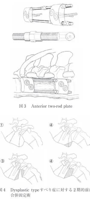 図 3  Anterior two-rod plate