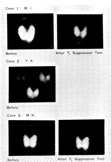Fig.  1.  Thyroid  scintigraphies  by  911.1Tc  pertechnetate  (Top  and  bottom) 