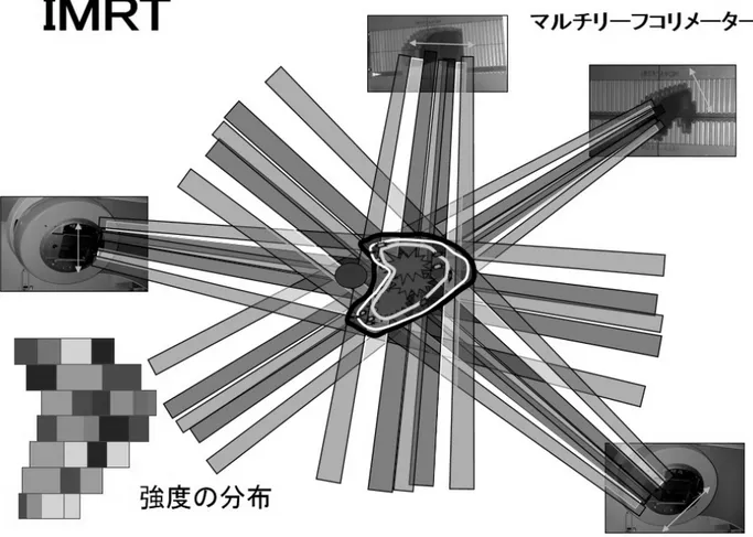 図 4  IMRT  強度変調放射線治療 