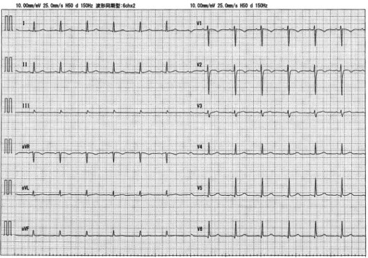Fig. 6 Possible pathomechanism of lethal ECG pattern.