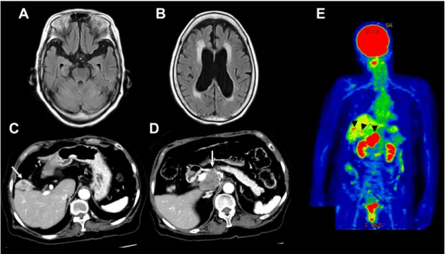 Fig. 1 Contrast enhanced CT and  11 F-fluorodeoxyglucose (FDG)-positron emission computed tomography (PET).