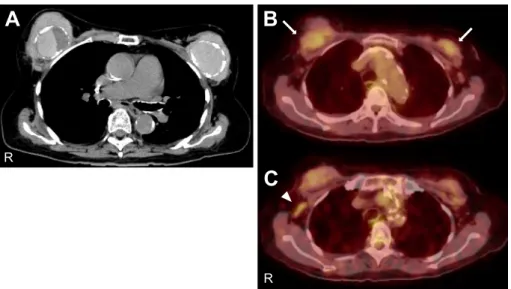 Fig. 1 Chest CT and FDG ( 18 F-fluorodeoxyglucose)-PET (positron emission tomography) images.
