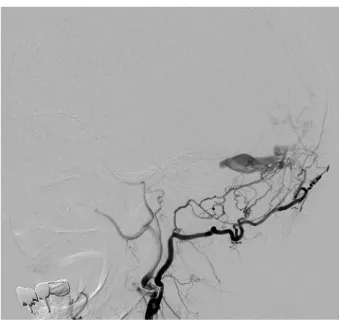 Fig. 3 External carotid angiography.