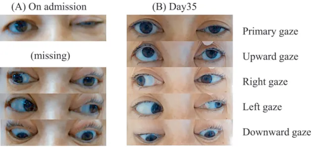 Fig. 1 Recorded eye movement of a patient with left-side ptosis.