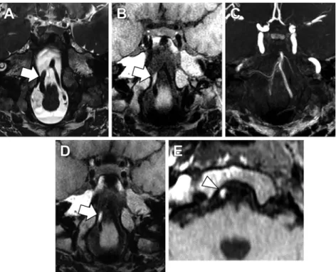 Fig. 4 A 50-year-old man with right vertebral artery dissection.