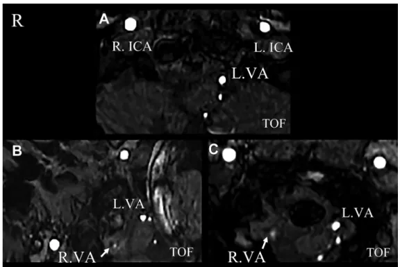 Fig. 3 Flow signal changes in the right vertebral artery due to neck.
