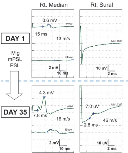Fig. 2 Results of nerve conduction study after immune therapy.