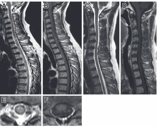Fig. 1 MRI of the spinal cord.