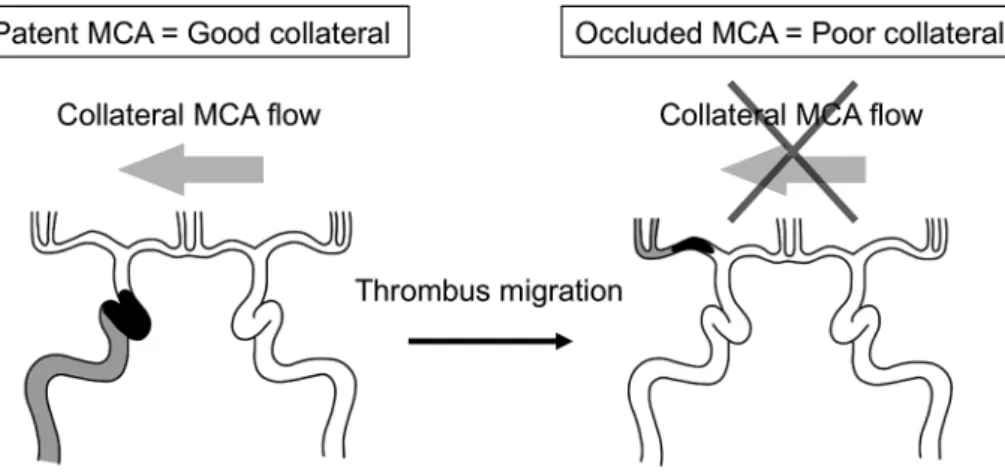 Fig. 1 Schematic of internal carotid artery (ICA) occlusion with a patent middle cerebral artery (MCA) and thrombus migration.
