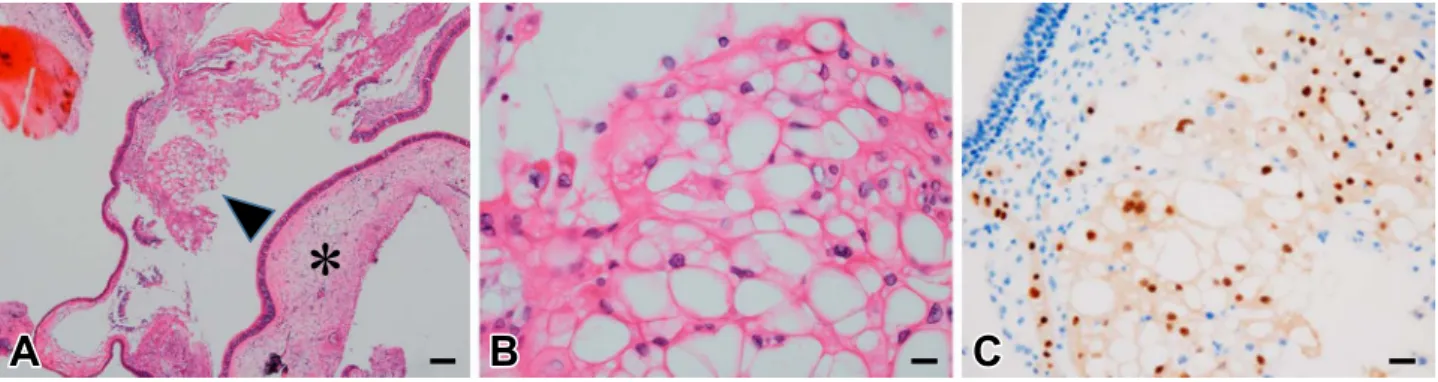 Fig. 2 Pathological findings of resected sphenoid sinus mucosa around the clival bone defect.