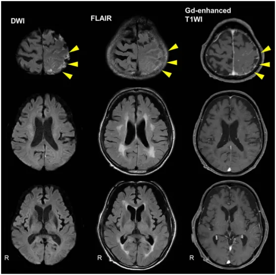 Fig. 1 Brain magnetic resonance imaging (MRI) on day 5.