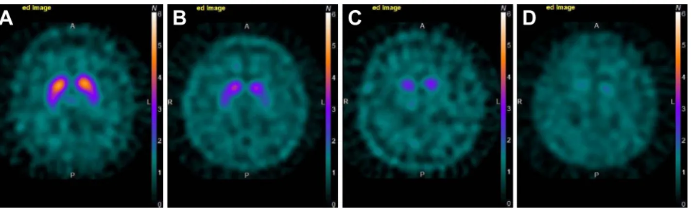 Fig. 1 Four grades of  123 I-ioflupane findings in visual assessment.