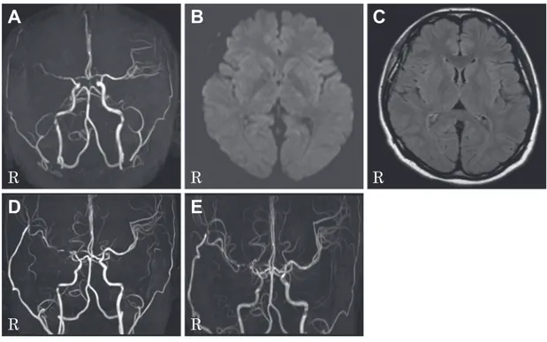 Fig. 1 Findings of brain MRI and MRA.