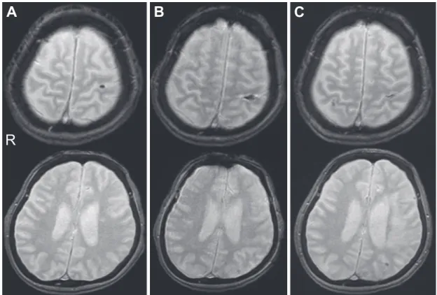 Fig. 3 T 2  star weighted image of during admission.