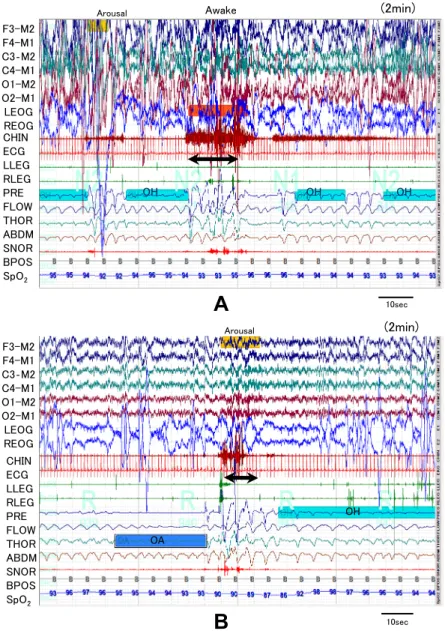 Fig. 2 Polysomnography examples of vocalization or speech.