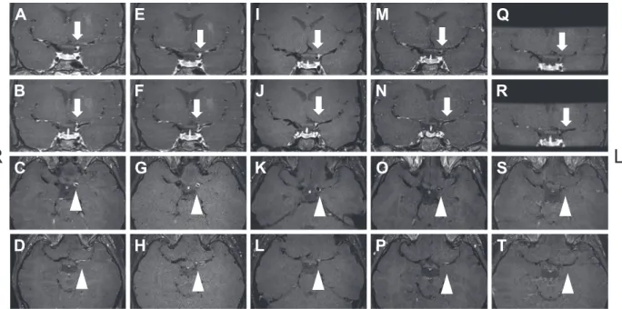 Fig. 3 Gadolinium-enhanced T 1  Weighted MRI.