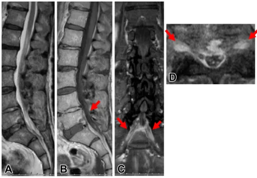 Fig. 2　FDG-PET findings.
