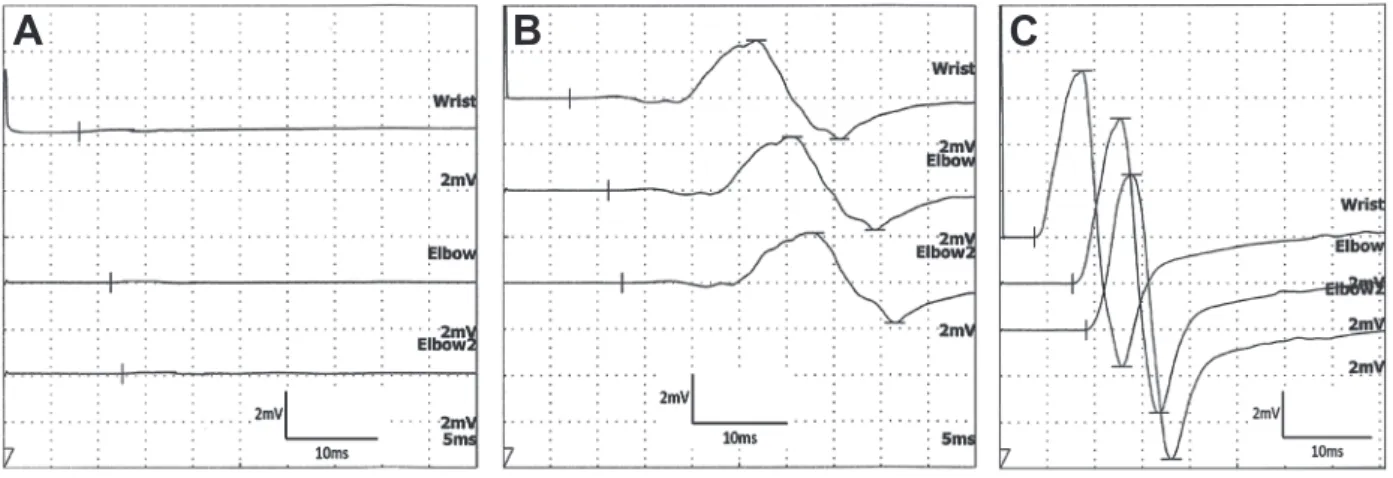 Fig. 1 The nerve conduction study of right ulnar motor nerve.