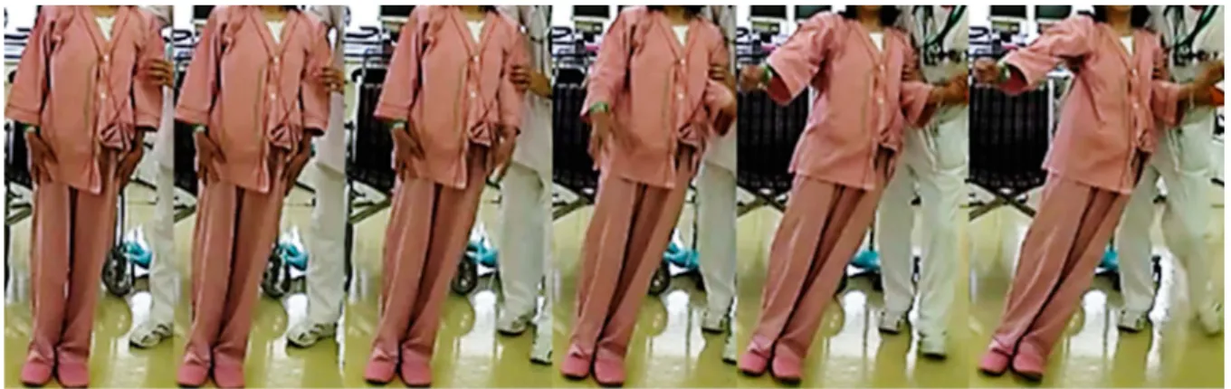Fig. 1 Body lateropulsion to the left.