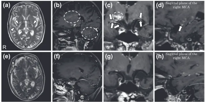Fig. 2 Histological brain biopsy findings from the right insular subcortical lesion.