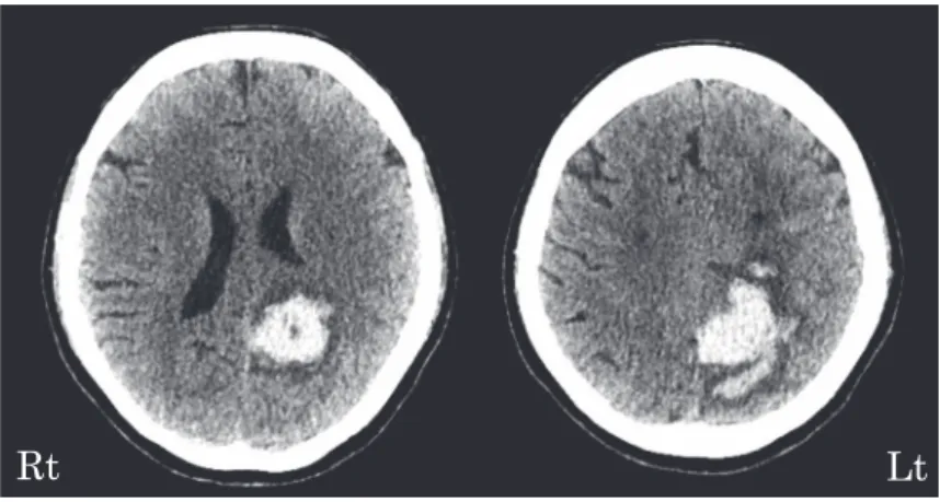 Fig. 2　Brain MRI findings on admission (April 2017).