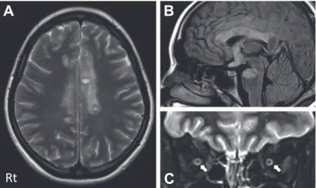 Fig. 3 MRI and contrast CT at 16 and 22 days after admission.