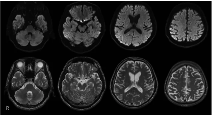 Fig. 2  99 mTc-ECD single photon emission computed tomography findings from the initial admission.