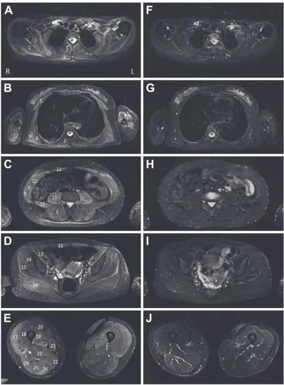 Fig. 1 Axial short-tau inversion recovery (STIR) whole-body MRI images in acute exacerbation period (A–E) and post-treatment period (F–J).