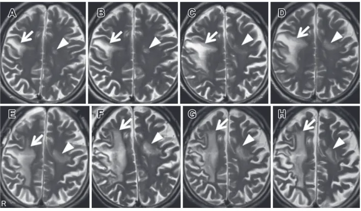 Fig. 2 Chronological changes of the head magnetic resonance imaging findings.