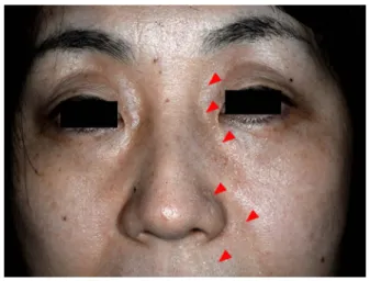 Fig. 1 Sweating of the face.