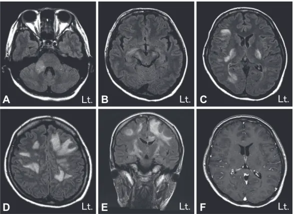 Fig. 1 Brain MRI findings.