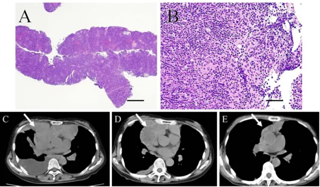 Fig. 1 Histological feature of the thymoma and chest CT images of the patients.