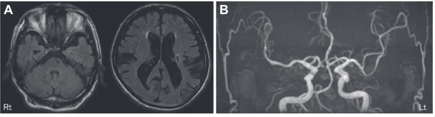 Fig. 2 Brain MRA findings.